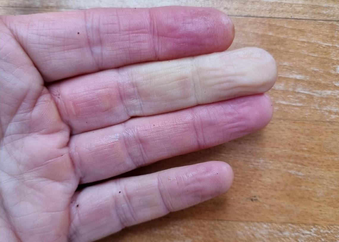Four fingers, with middle finder showing classic Raynaud's symptom of colour loss.